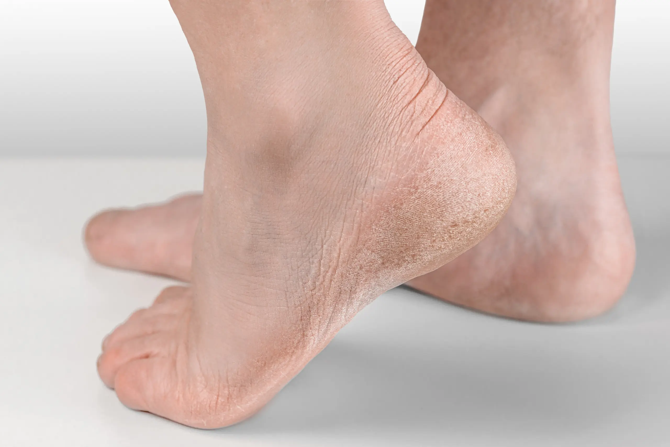 Dry and Cracked Heels