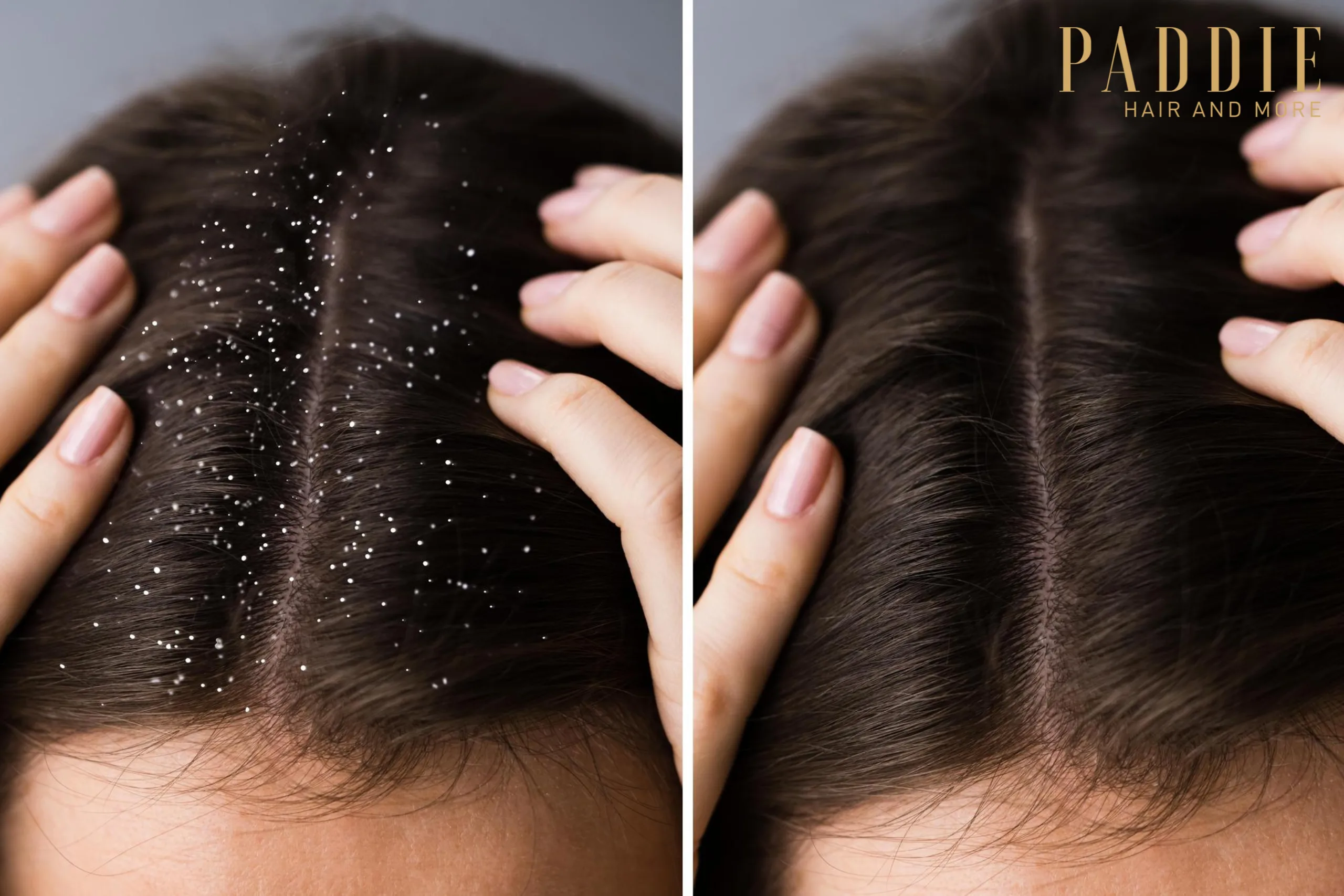 Anti-dandruff hair treatment